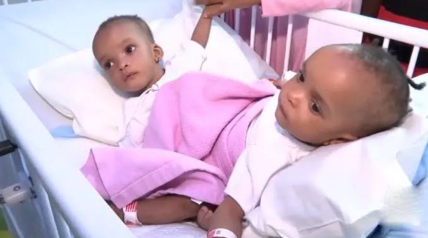 المملكة... بدء عملية فصل التوأم السيامي النيجيري بمشاركة 35 كادر طبي متخصص