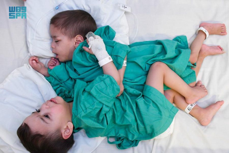 إجراء عملية فصل التوأم السيامي السوري "بسام وإحسان" اليوم