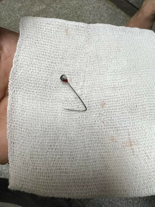 مستشفى بنها الجامعى ينقذ فتاة ابتلعت «دبوس طرحة»