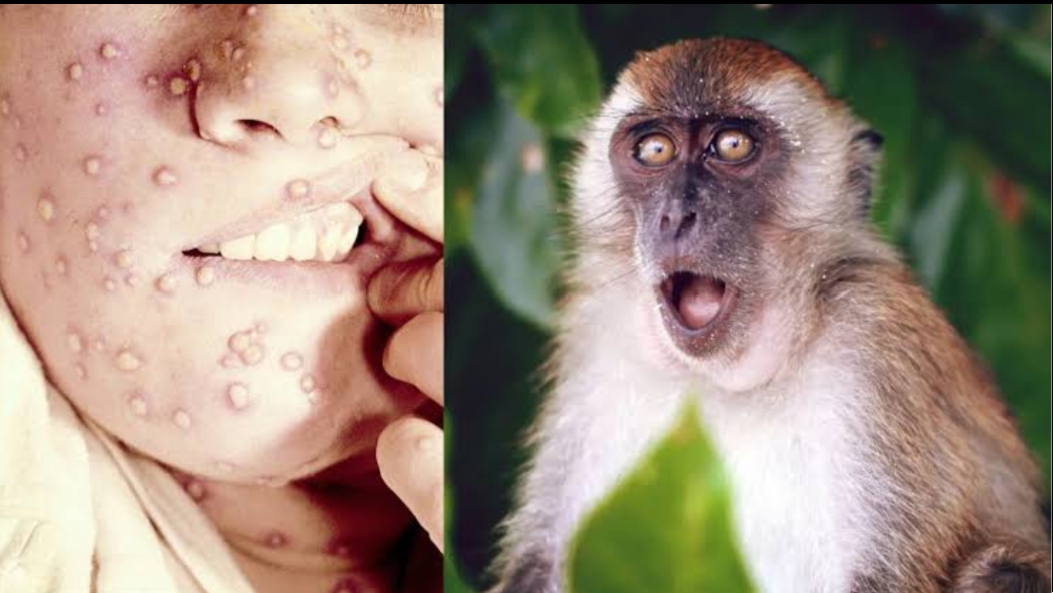 رصد أول حالة إصابة جدري القرود بالمغرب