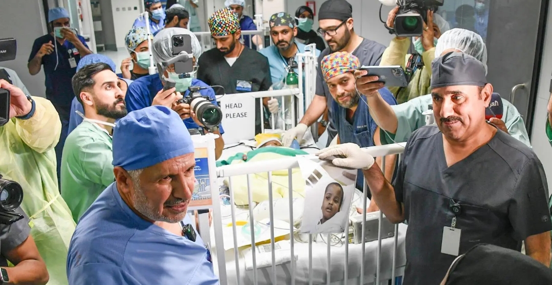 نجاح عملية فصل التوأم السيامي التنزاني "حسن وحسين" بعد جراحة معقدة استغرقت 16 ساعة