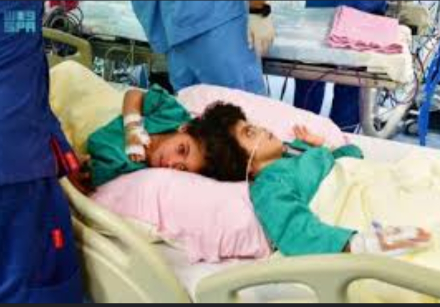 نجاح فصل التوأم السيامي المصري " سلمى وسارة " بعد عملية جراحية معقدة استغرقت 17 ساعة