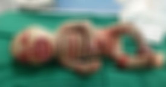 مدير مستشفيات البحر الأحمر يكشف حقيقة ولادة "طفل شمعي" كل شهر بالمحافظة