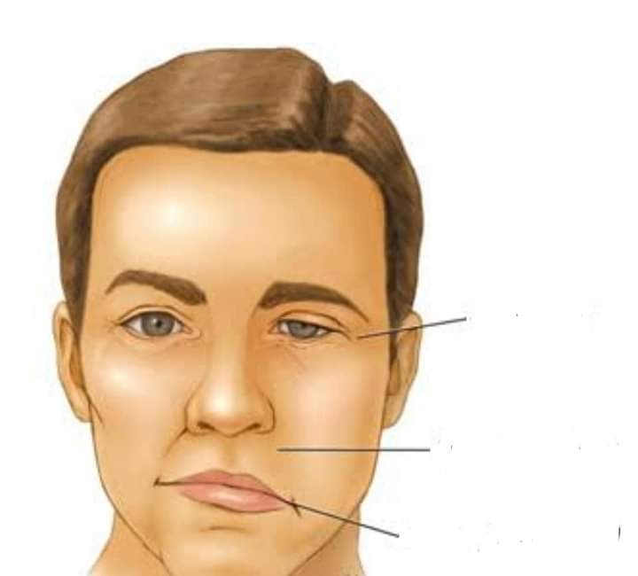 شلل العصب السابع