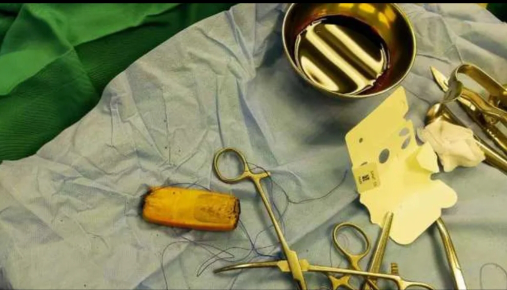 اسخراج «هاتف محمول» من معدة مريض بمستشفى المنصورة الدولي