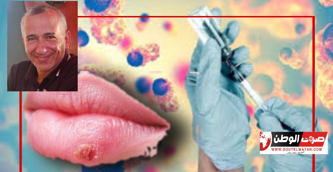 فيروس الهربس ورؤي جديدة للعلاج