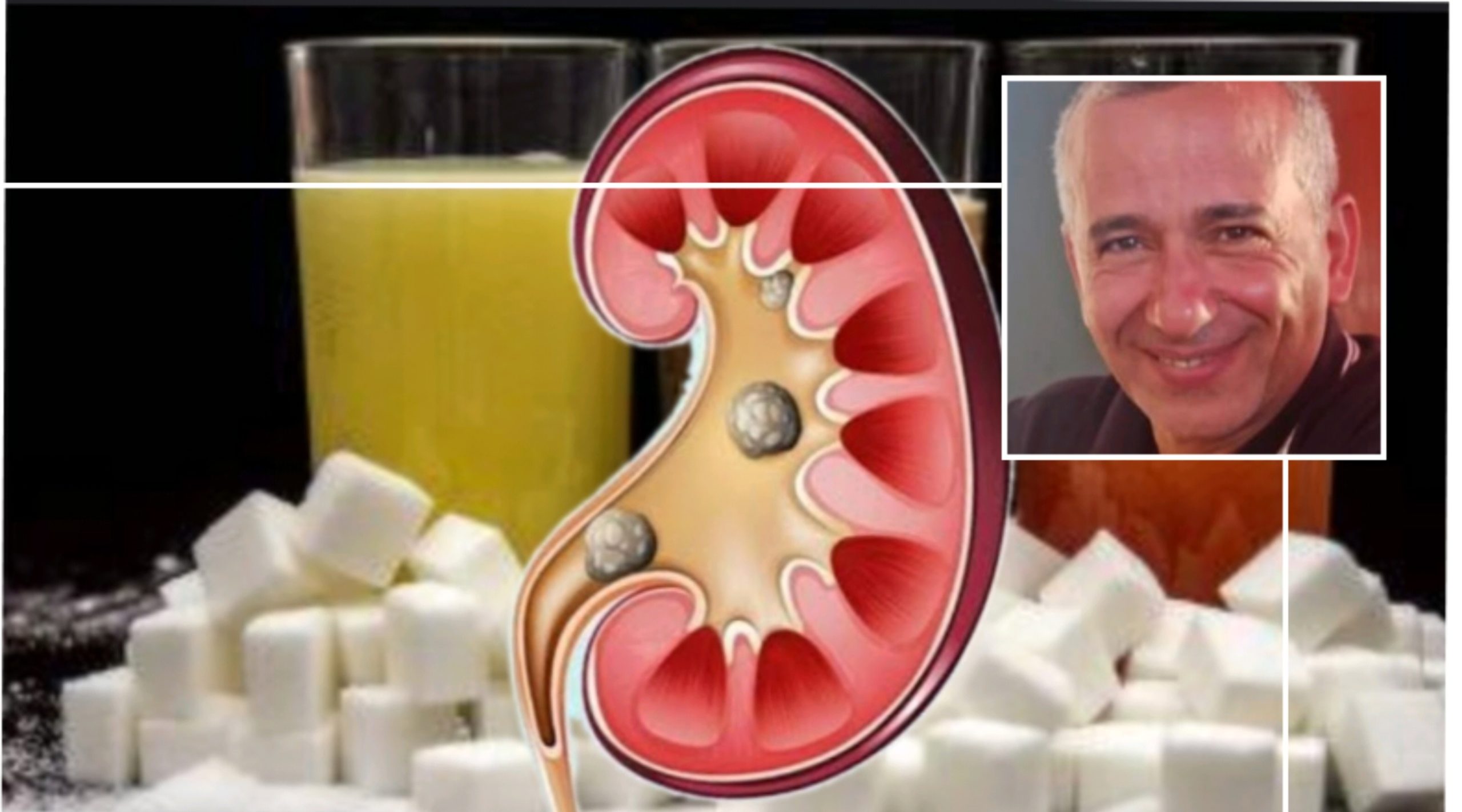 حصوات الكلى تزيد مع إستهلاك السكريات المضافة