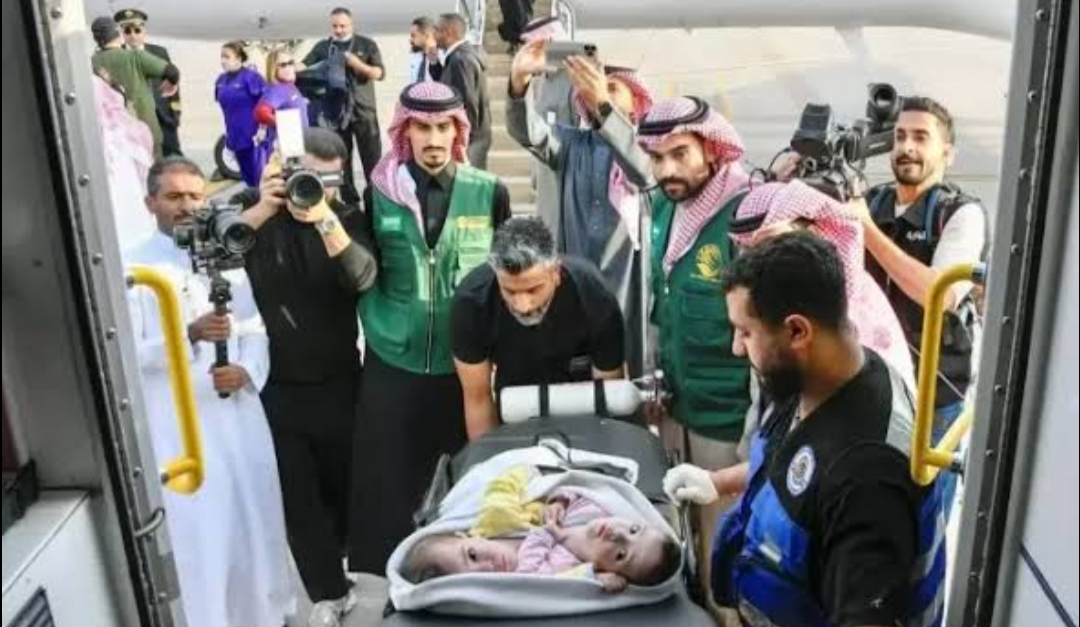 بتوجيهات القياده السعوديه...وصول التوأم الملتصق السوري "سيلين وإيلين" إلى الرياض