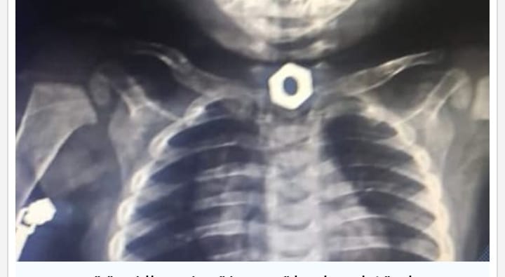 إستخراج " صامولة حديد" من جسم طفل عمره8سنوات