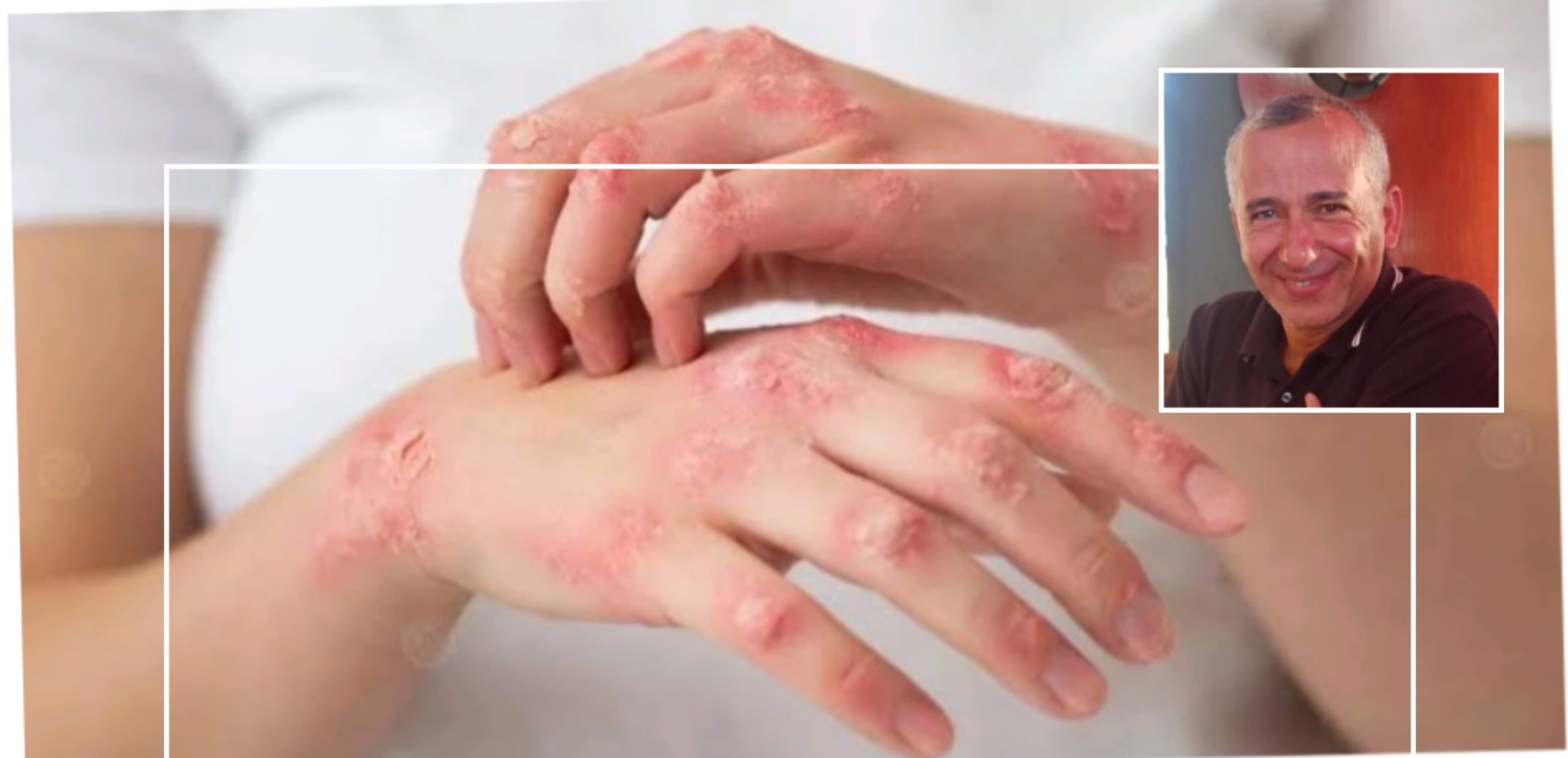 الإكزيما ودور البكتريا العنقودية في تفاقم المرض