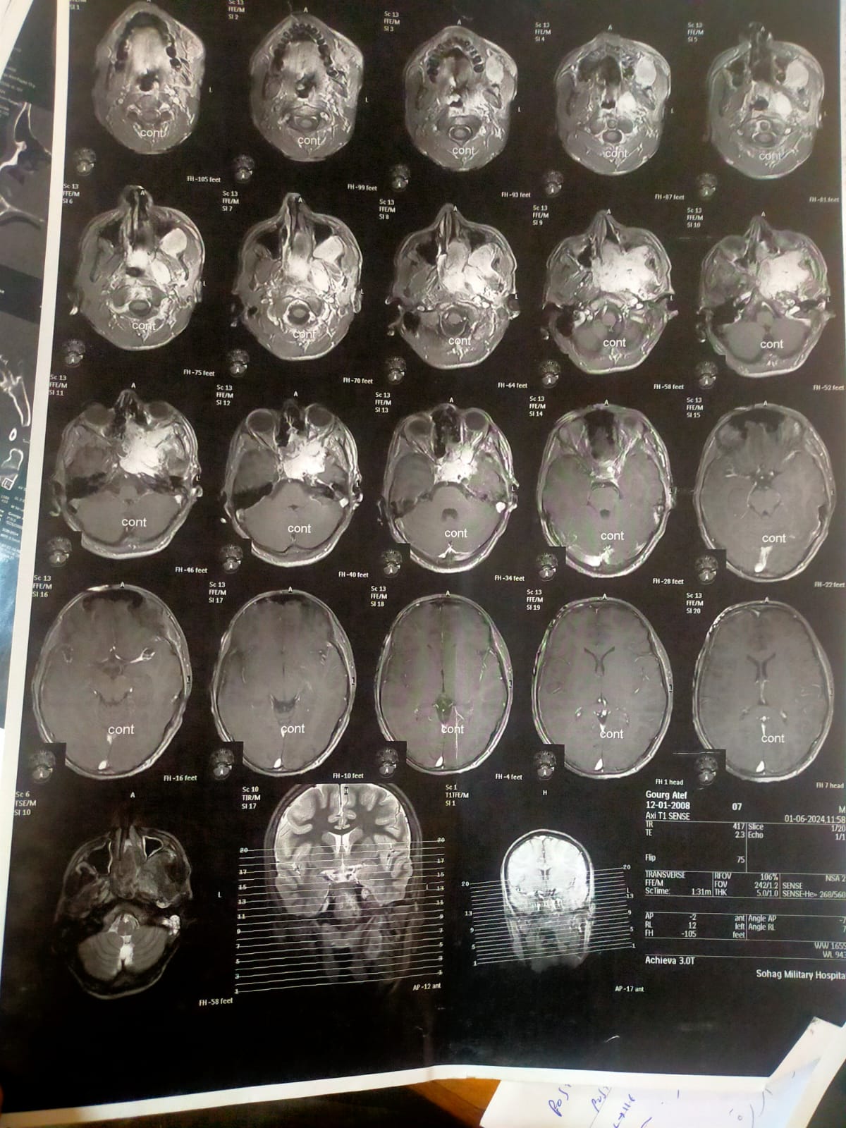 سوهاج الجامعي" ينجح في استئصال "ورم دموي في الأنف ممتد للمخ
