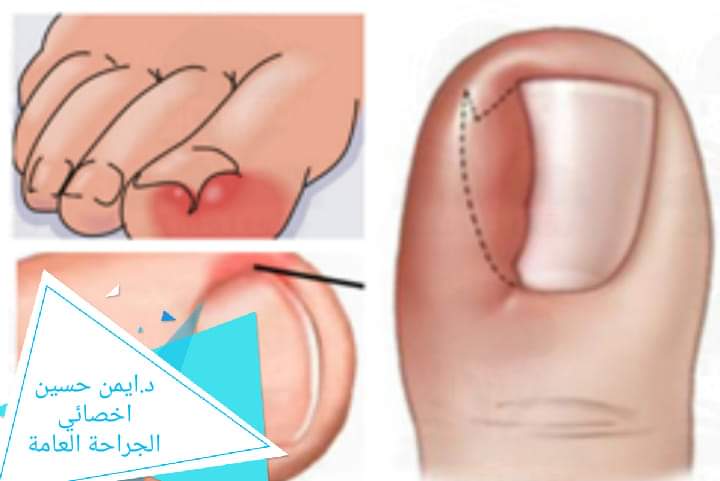ما هو «الظفر الغائر»»