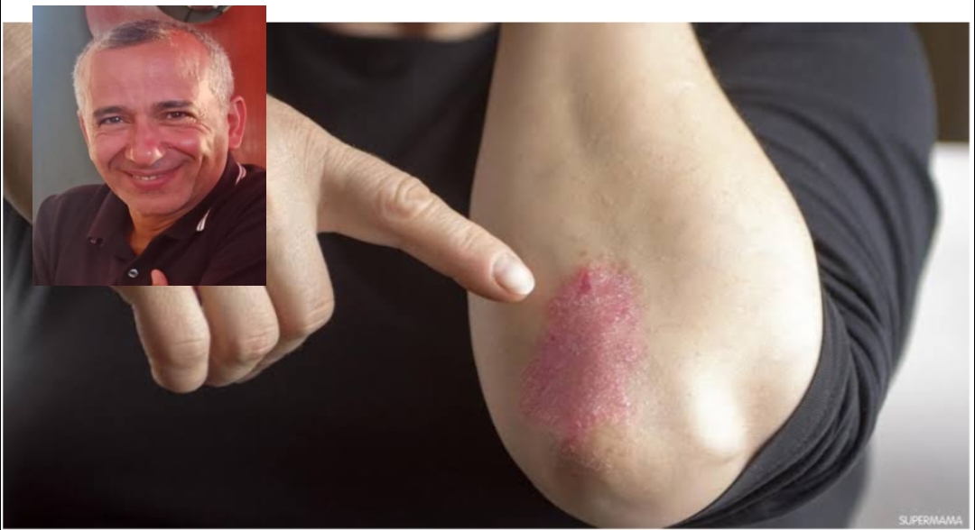 الصدفية....وكيفية التعامل مع الإلتهابات المزمنة