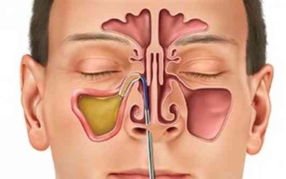 مع اقتراب موسم الربيع ...كيفية التعامل مع الجيوب الأنفية