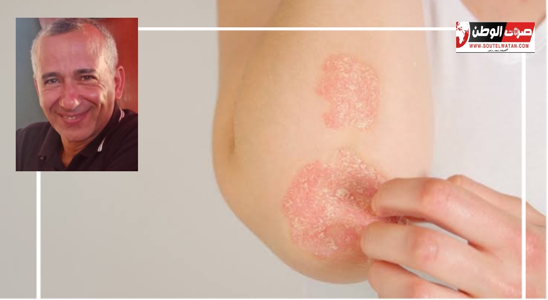 الصدفية ودراسة جديدة 