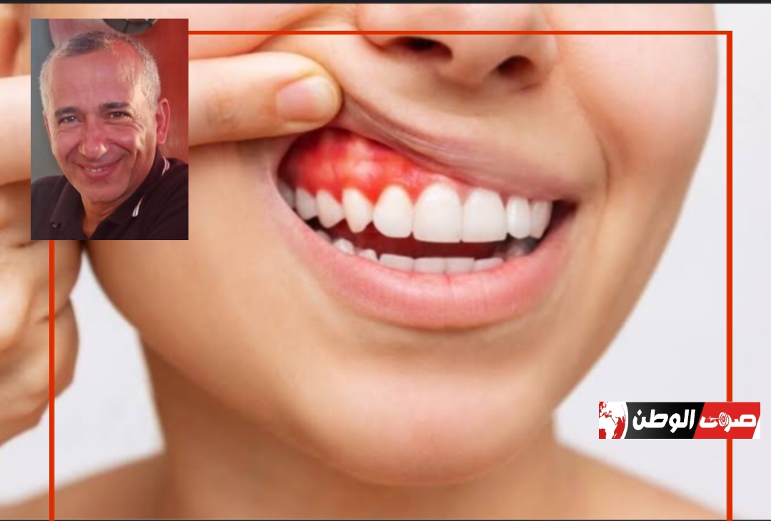 التهابات اللثة.... ونهج جديد للعلاج 