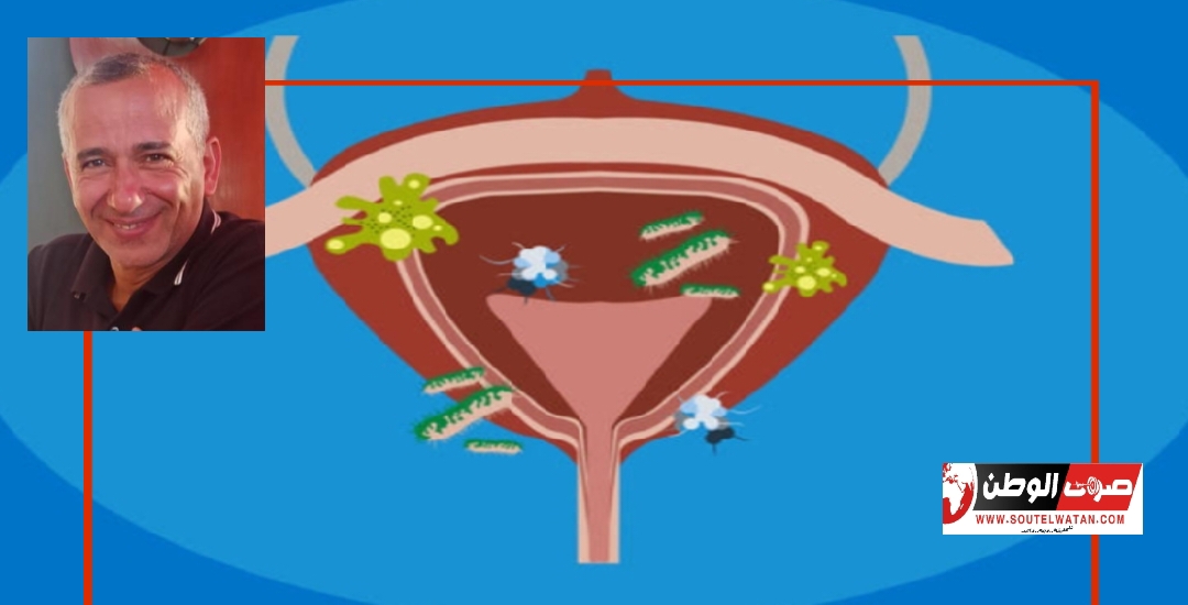 إلتهاب المسالك البولية المزمن والكشف عن البكتريا المختبئة في المثانة