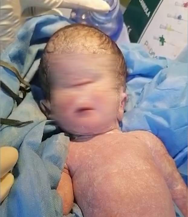 حالة نادرة الحدوث....ولادة طفلة بعين واحدة وتتوفي مباشرة بعد ولادته