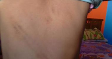 العثور على طفل معاق به أثار تعذيب بالمرج..والمباحث تكثف تحرياتها حول الواقعة